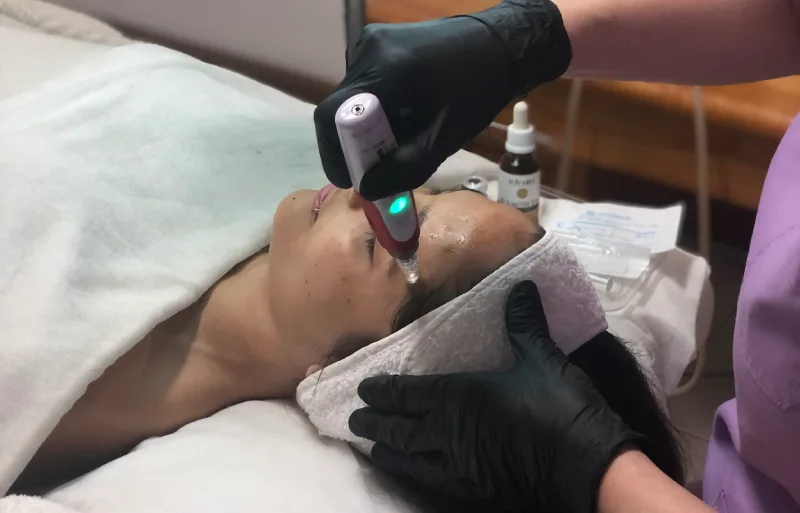 Limpieza facial con microneedling